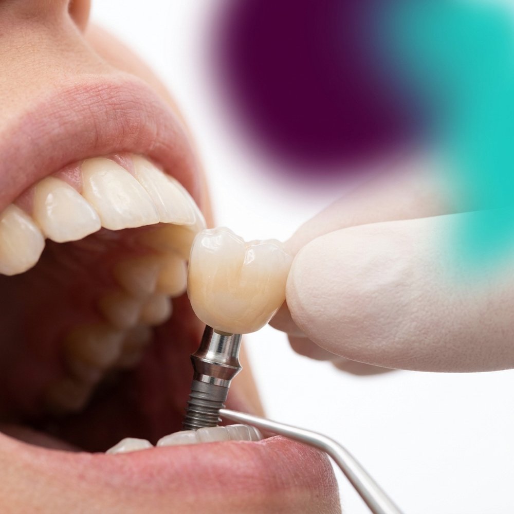 Coroa protética sobre implante em modelo dentário